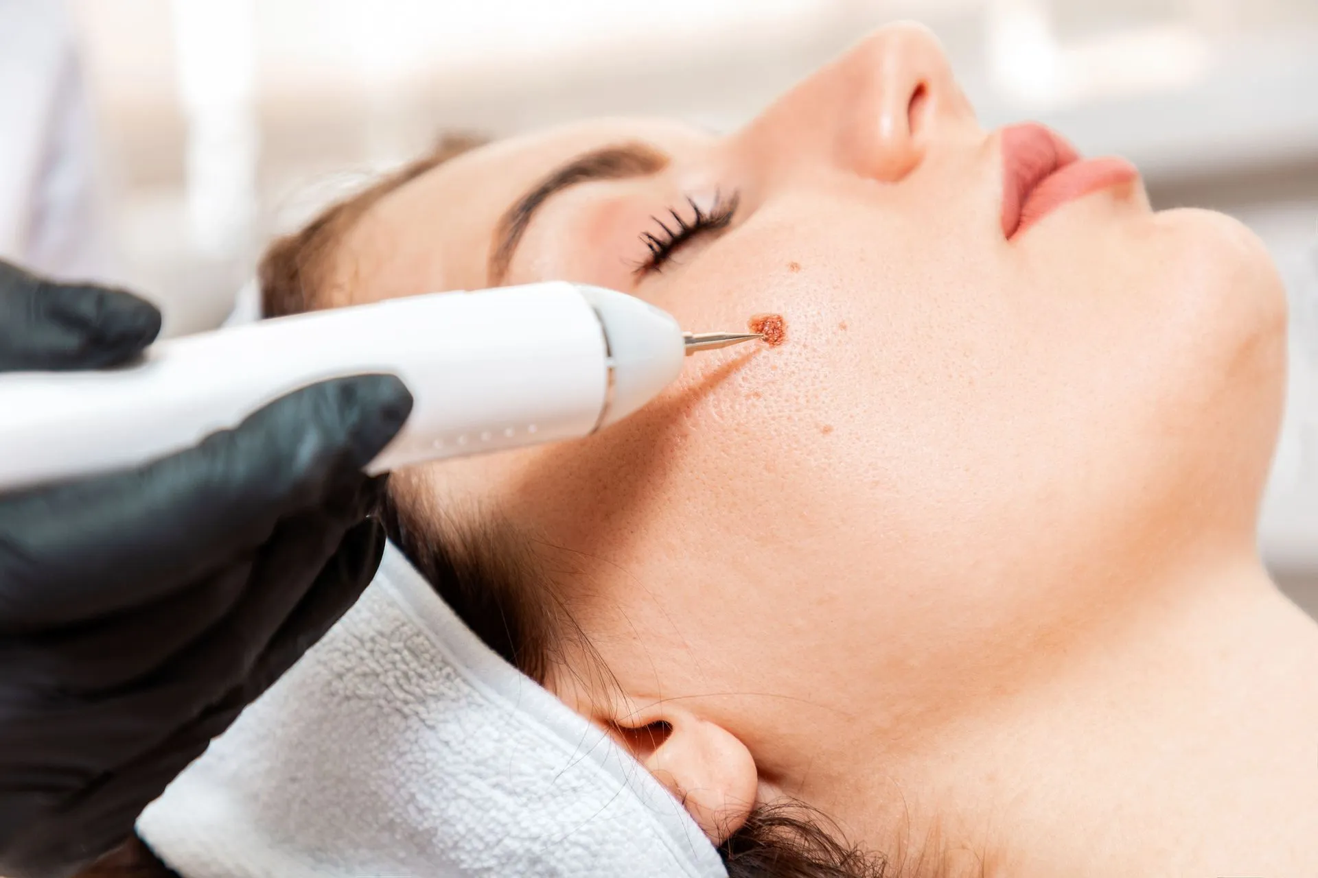 skin tag removal in Dubai