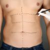 Restore Abdominal Firmness with Tummy Tuck Surgery in Islamabad tummy tuck surgery in islamabad