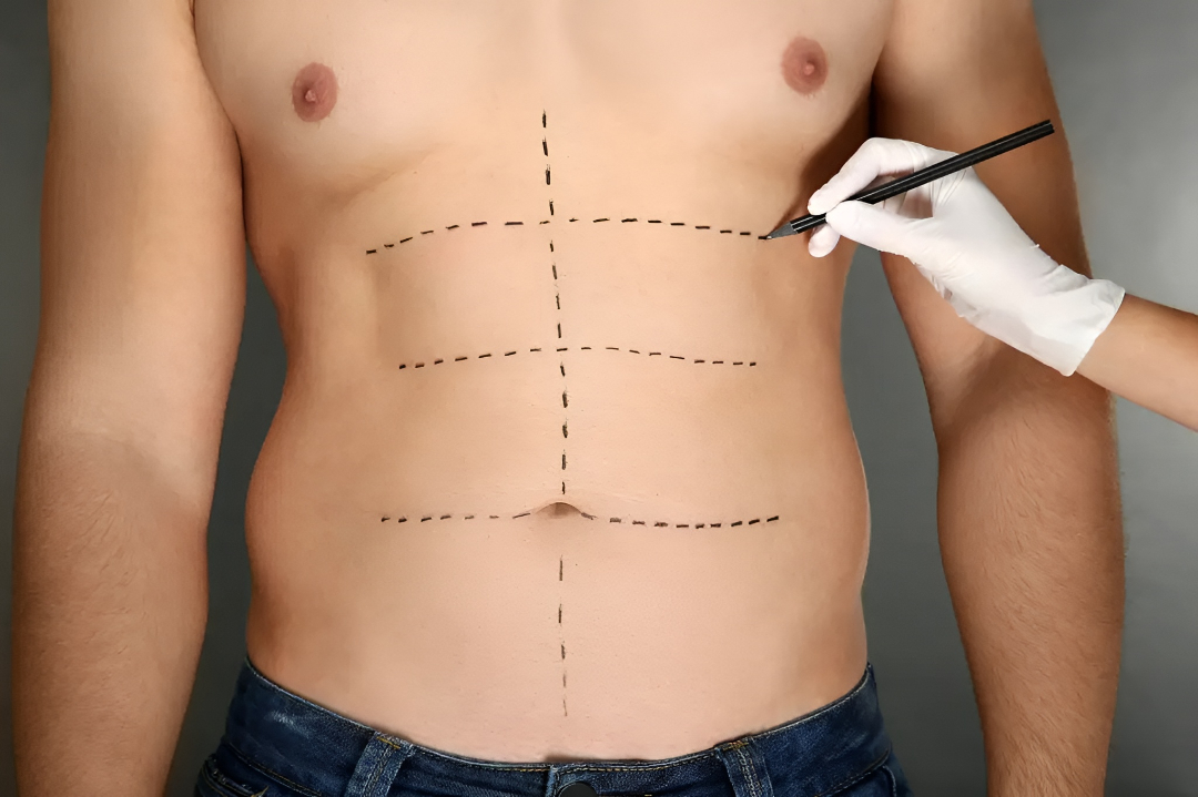 Restore Abdominal Firmness with Tummy Tuck Surgery in Islamabad